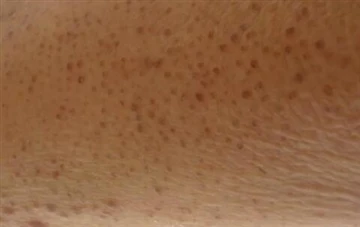 Kan 2-hydroxyazijnzuur keratosis pilaris behandelen?